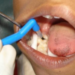 Prevention of cavity