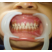 Replacement of missing milk teeth