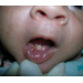 Tooth present at birth - natal teeth