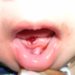 Natal/ Neonatal Teeth